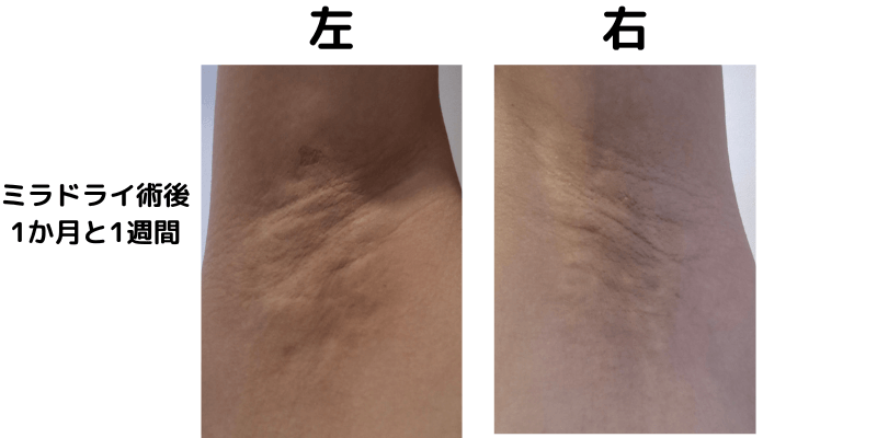 ミラドライ術後1ヶ月と1週間の経過写真