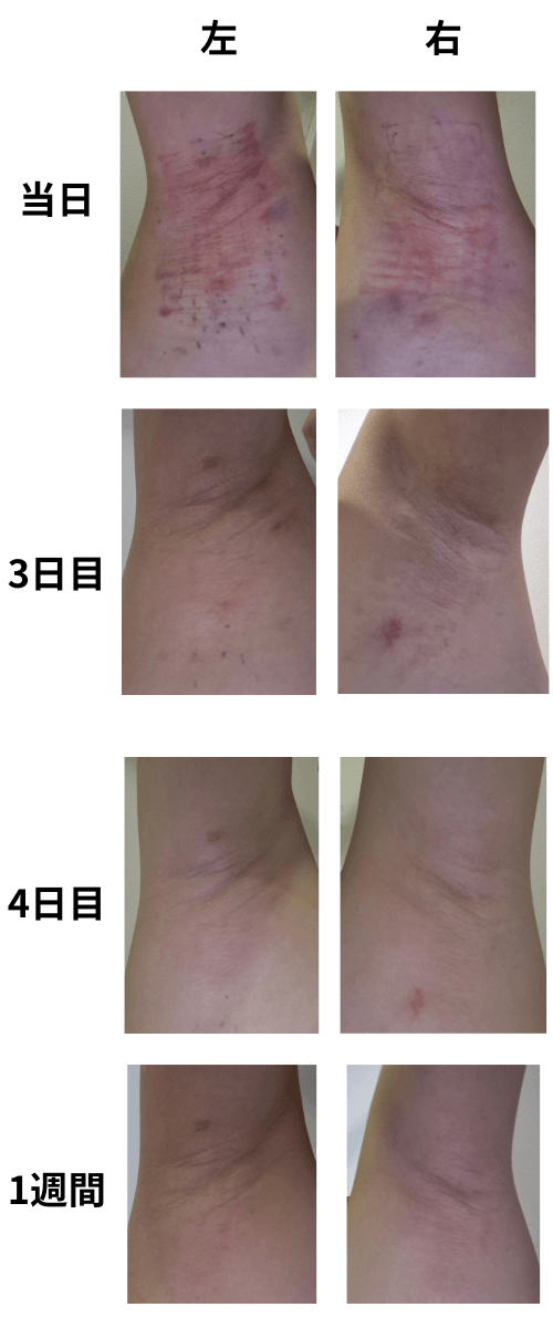 ミラドライ術後1週間までの経過写真